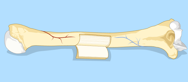 En knokkel hvor et felt av det ytterste laget er skåret ut og brettet til side. Illustrasjon.