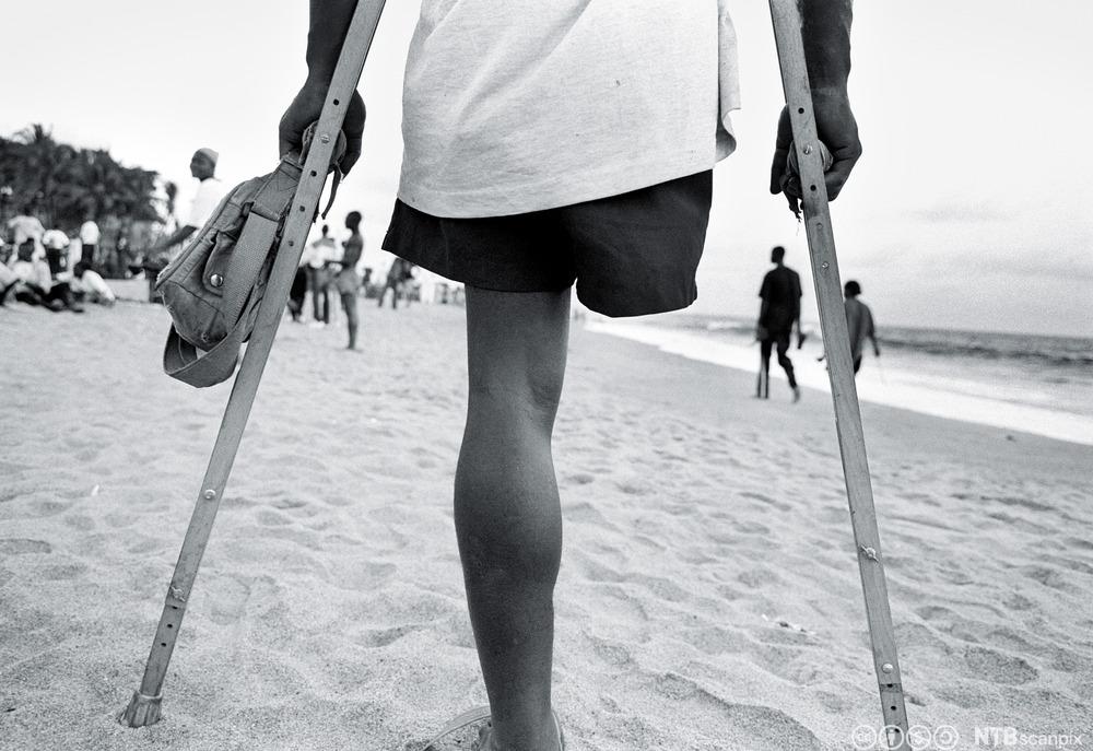 Et barn på krykker som har mistet et ben. Foto.