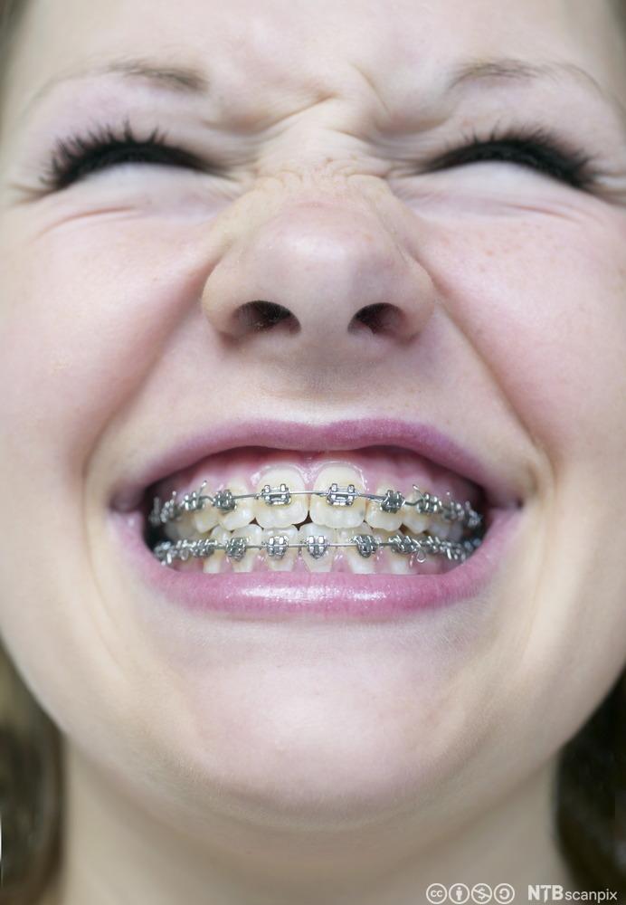 Jente med dobbeltsidig tannregulering, som smiler stort. Foto.