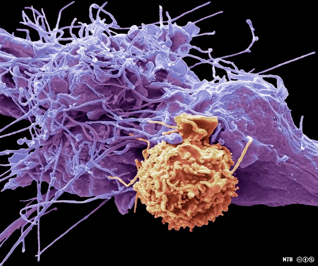 En NK-celle angriper en kreftcelle. Mikroskopfoto.