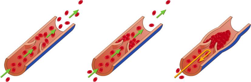Tre tegninger som viser hvordan en blodpropp gradvis tetter ei blodåre slik at blodet ikke kan strømme gjennom. Illustrasjon.