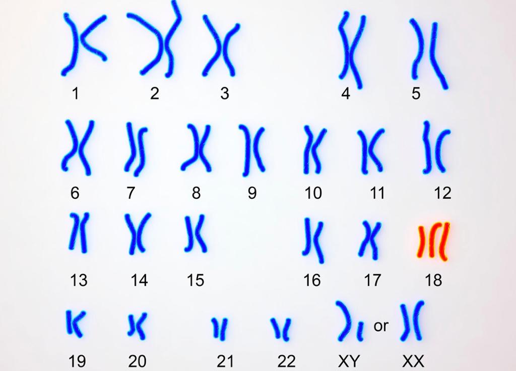 Kromosomkart som viser et ekstra kromomsom på krosompar 18. Illustrasjon.