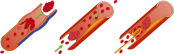 Tre tegninger som viser hvordan en bit av en blodpropp løsner, fraktes videre med blodstrømmen og setter seg fast i ei mindre blodåre. Illustrasjon.