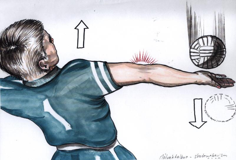 Målvakt som redder en ball med innsiden hånden, slik at albuen blir belastet. Illustrasjon. 