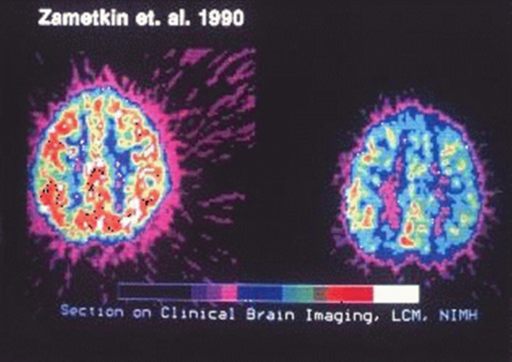 Røntgen-analyse av to hjerner på en skjerm. Foto.