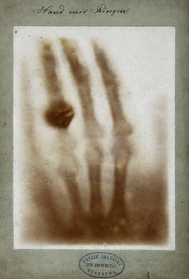 Et gammelt og litt utydelig røntgenbilde av en hånd med en ring. Foto.
