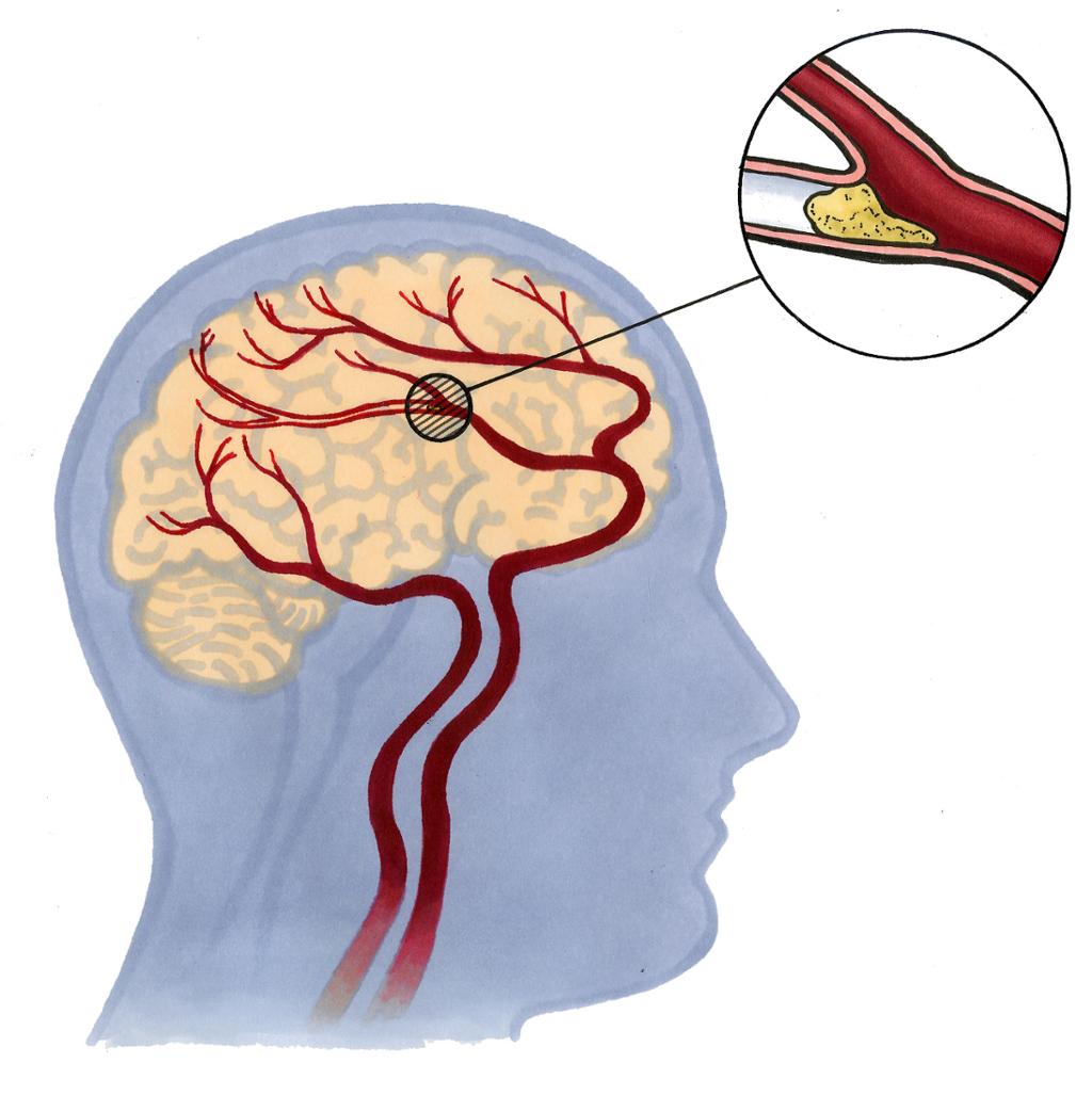 Blodpropp i hjernen. Illustrasjon.