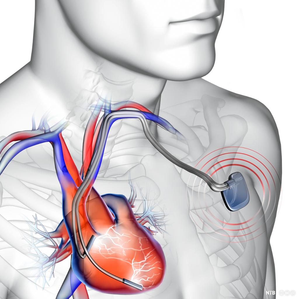 En pacemaker er koblet på hjertet. Illustrasjon