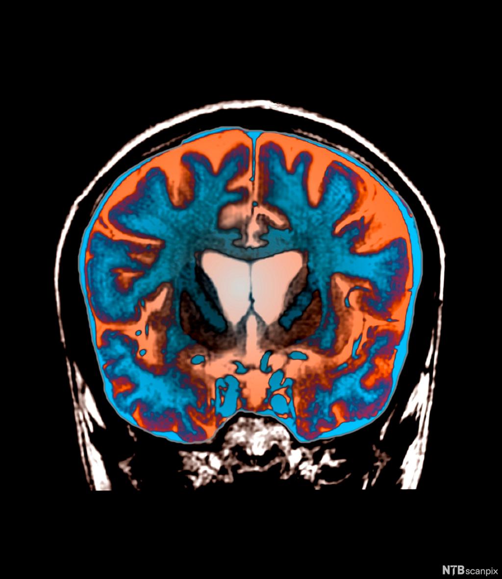 Huntingtons sykdom, MR-bilde av hjernen. Foto.