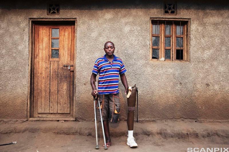 krigsskadet mann fra Kongo med amputert bein. Foto.