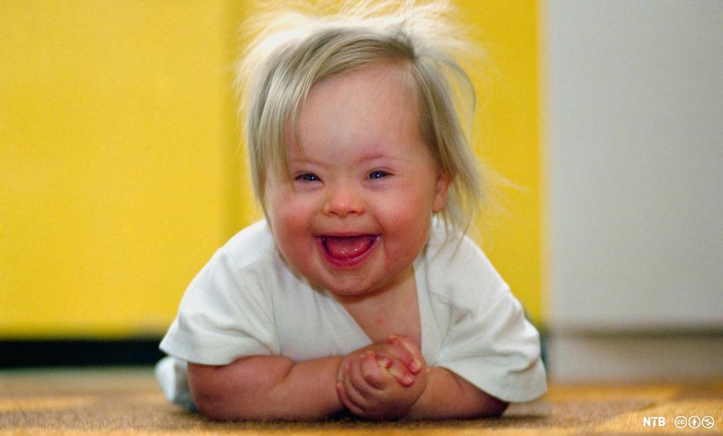 Eit lite barn ligg på magen og smiler mot kamera. Barnet har skråstilte auge og ansiktstrekk som er karakteristiske for Downs syndrom. Foto.