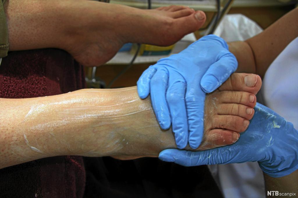Ein person med blå plasthanskar smør inn ein fot med krem. Foto.