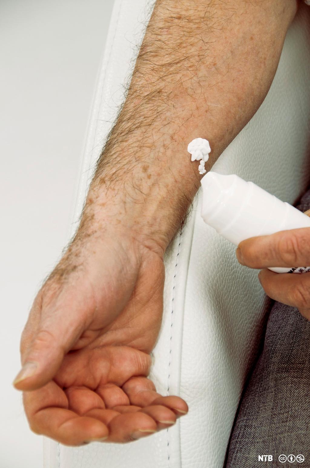 En mannlig underarm blir smurt inn med krem. Foto.