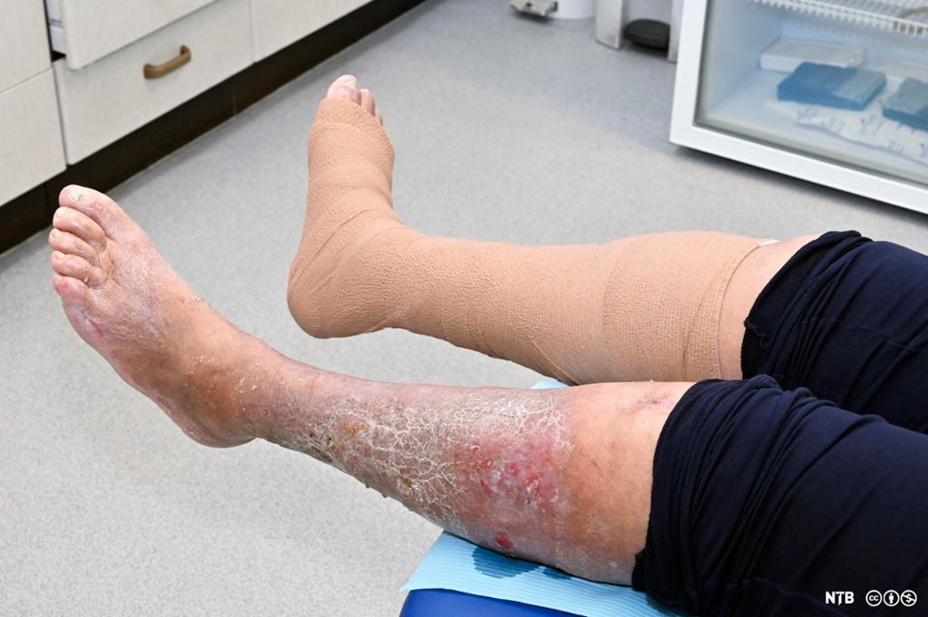 Beina til pasient med væskende eksem. Høyre bein er bandasjert med komprimerende bandasje. Foto.