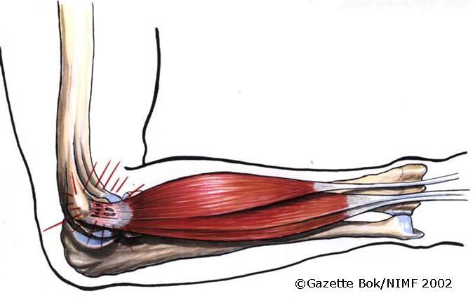 Illustrasjon av en bøyd arm med røde streker inn mot albuen.