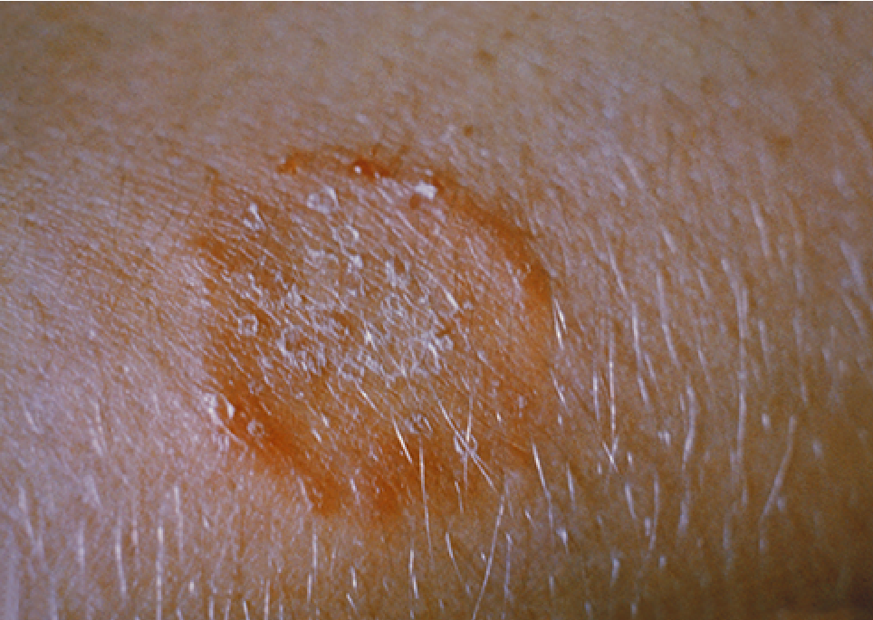  Nærbilde av hud med ringformet utslett. Foto.