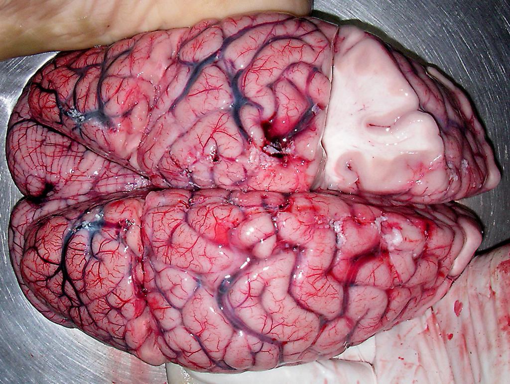 Foto av menneskehjerne med eit snitt som viser kvitt vev med myelin