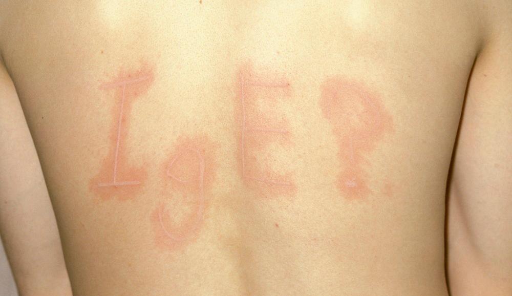 Bokstavene IgE er rispet på ryggen med for eksempel en negl, og mønsteret vises tydelig som rød hud.