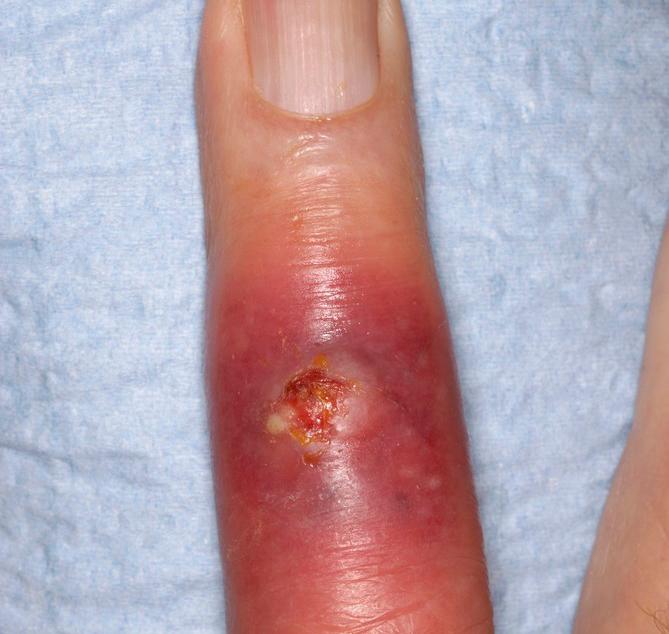 En finger med hissig betennelse og sår. Foto.