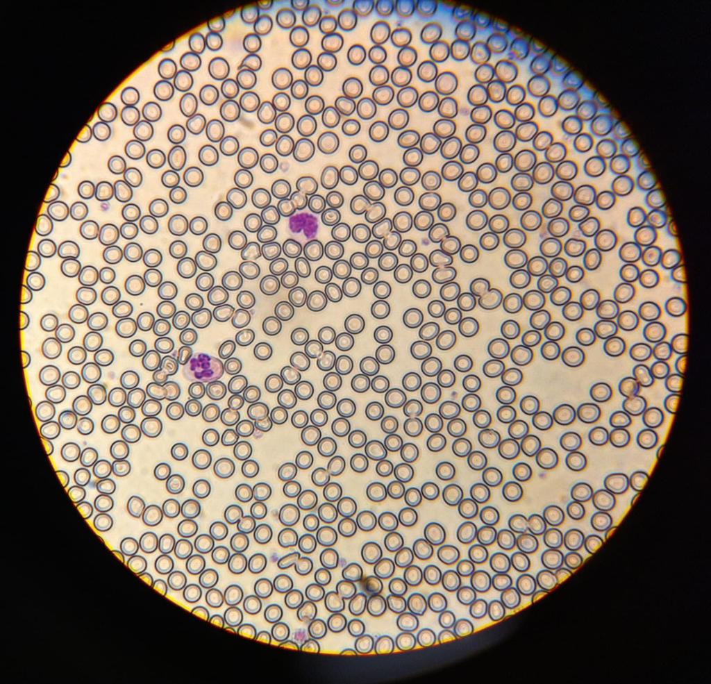 Bilde tatt gjennom okularet til et mikroskop. Preparatet er et farget blodutstryk som viser konturene av utallige røde blodceller samt to lillafargede hvite blodceller. Foto.