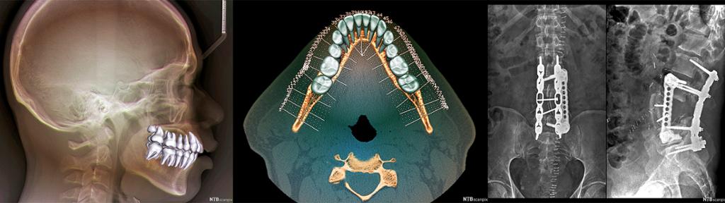 Tre røntgenbilder: normale tenner sett fra sida og ovenfra, og et bilde av en operert rygg med metallskinner. Foto.