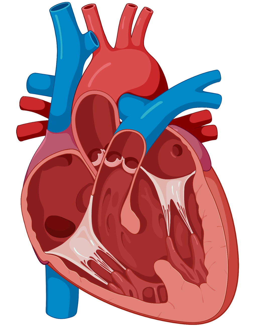 Tegning som viser hjerte med hull i hjerteskilleveggen