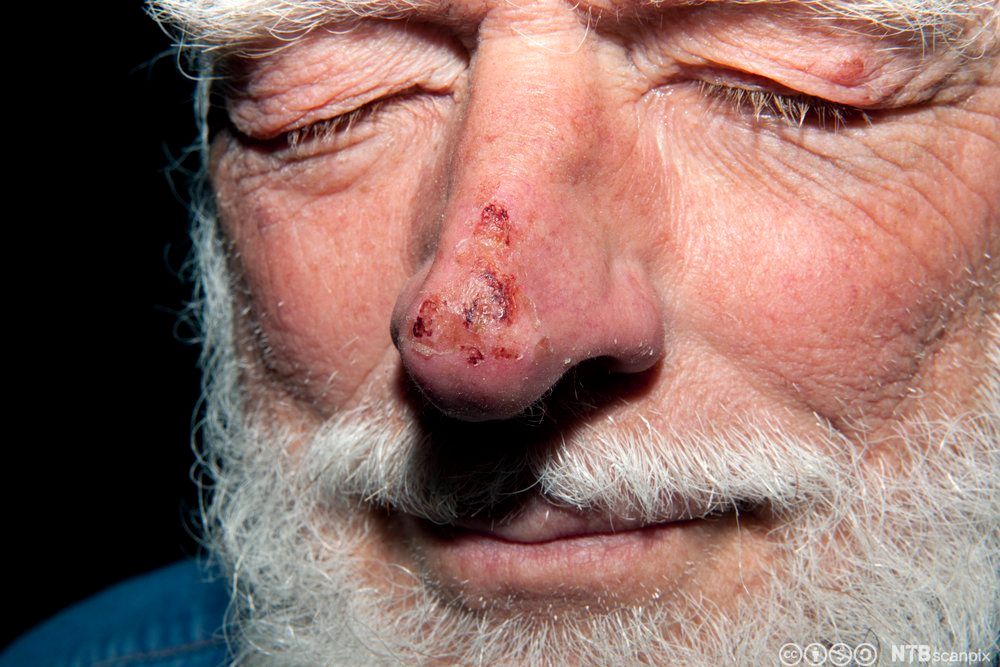 Nedkjøling og forfrysninger Arbeidsmiljø og dokumentasjon NDLA