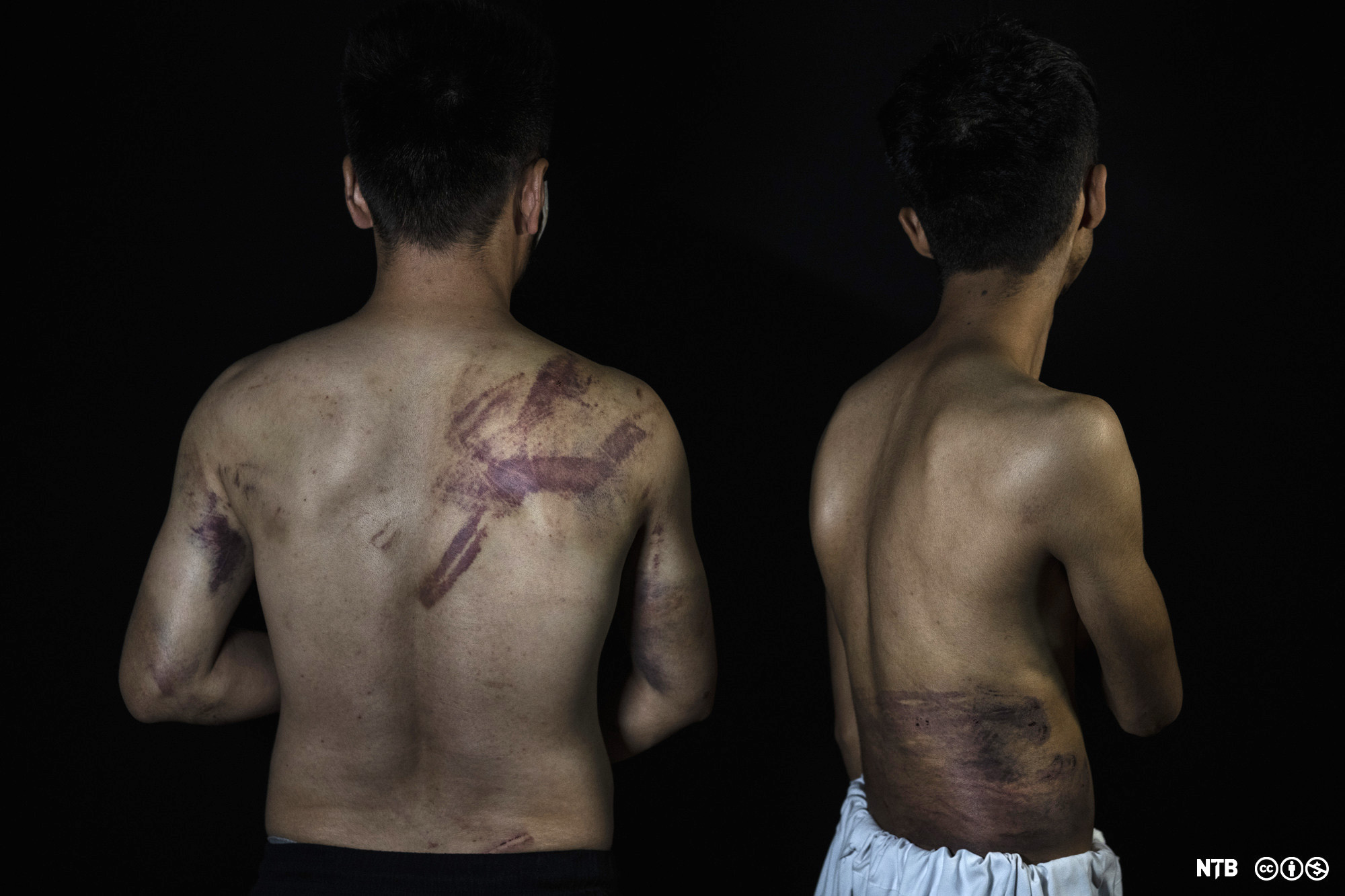 To menn står med ryggen til og viser skader på ryggen. Foto.