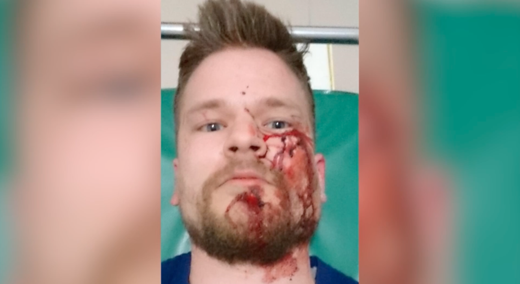 En skadet Øystein Windstad, journalist, etter et angrep på jobb i Tsjetsjenia. Blodet renner nedover kinnet og haka. Foto.
