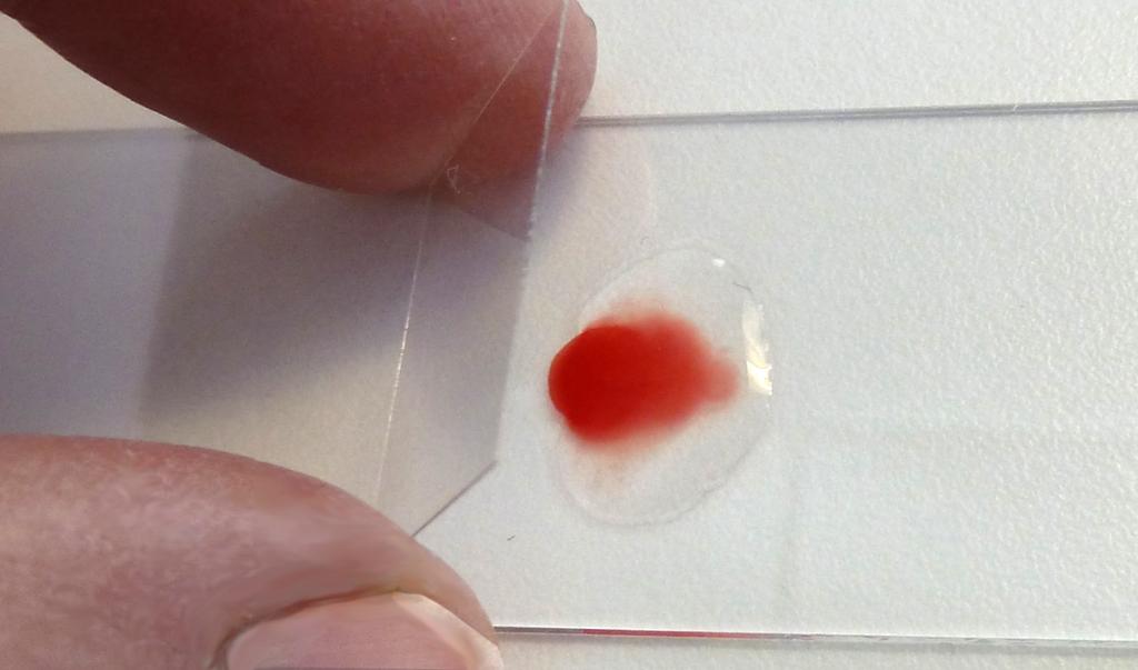 Foto av dekkglass som senkes mot bloddråpe og fysiologisk saltvann på objektglasset