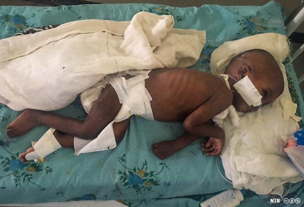 Eit lite, underernært afrikansk barn ligg i ei enkel sjukeseng med sonde i nasen. Foto.