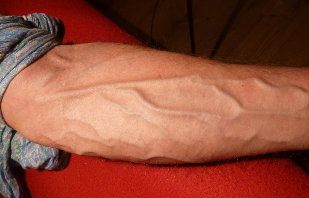 Foto av underarm med tydelige vener