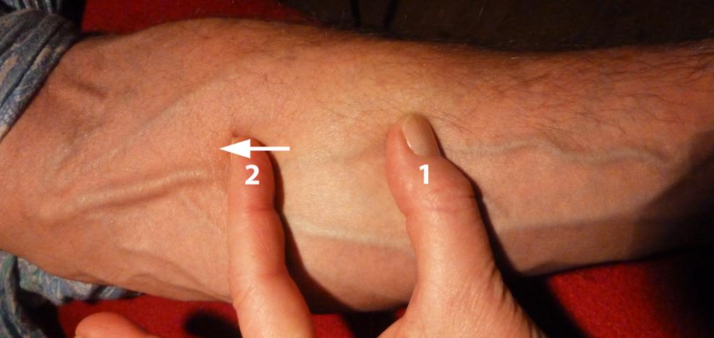 Underarm hvor to fingre stopper blodstrømmen i en vene.