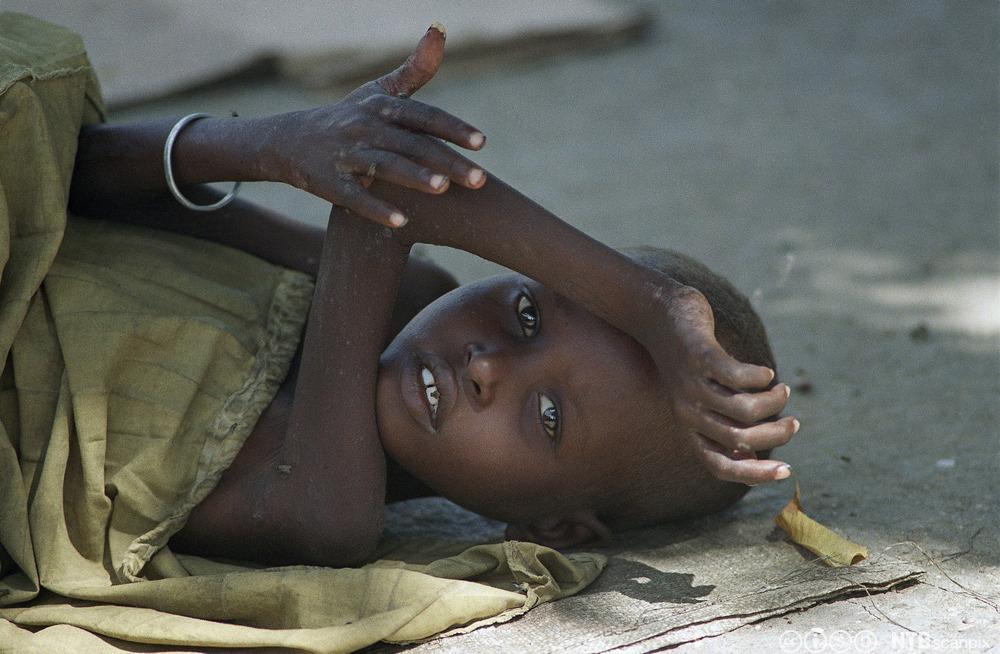 Et underernært og sykt barn under hungernøden i Somalia i 1992. Foto.