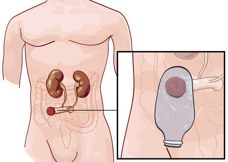 To tegninger. Den ene viser nyrene med urinlederne festet til en bit av tarmen og stomien som et rødt felt, mens den andre tegninga viser stomiposen som henger utenpå huden. Illustrasjon.