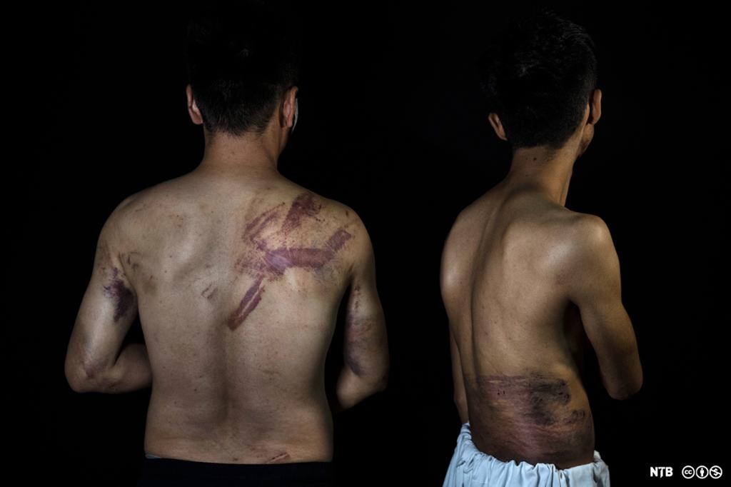 To menn står med ryggen til og viser skader på ryggen. Det er røde merker som sannsynligvis kommer av slag og pisking. Foto.